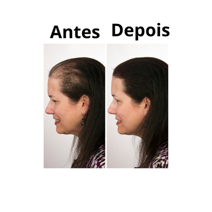 🌿 Spray Natural HZA™ para o Crescimento Capilar